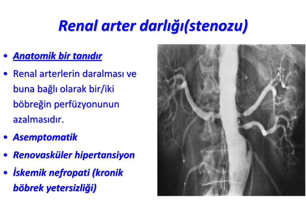 renal arteriyel hipertansiyon